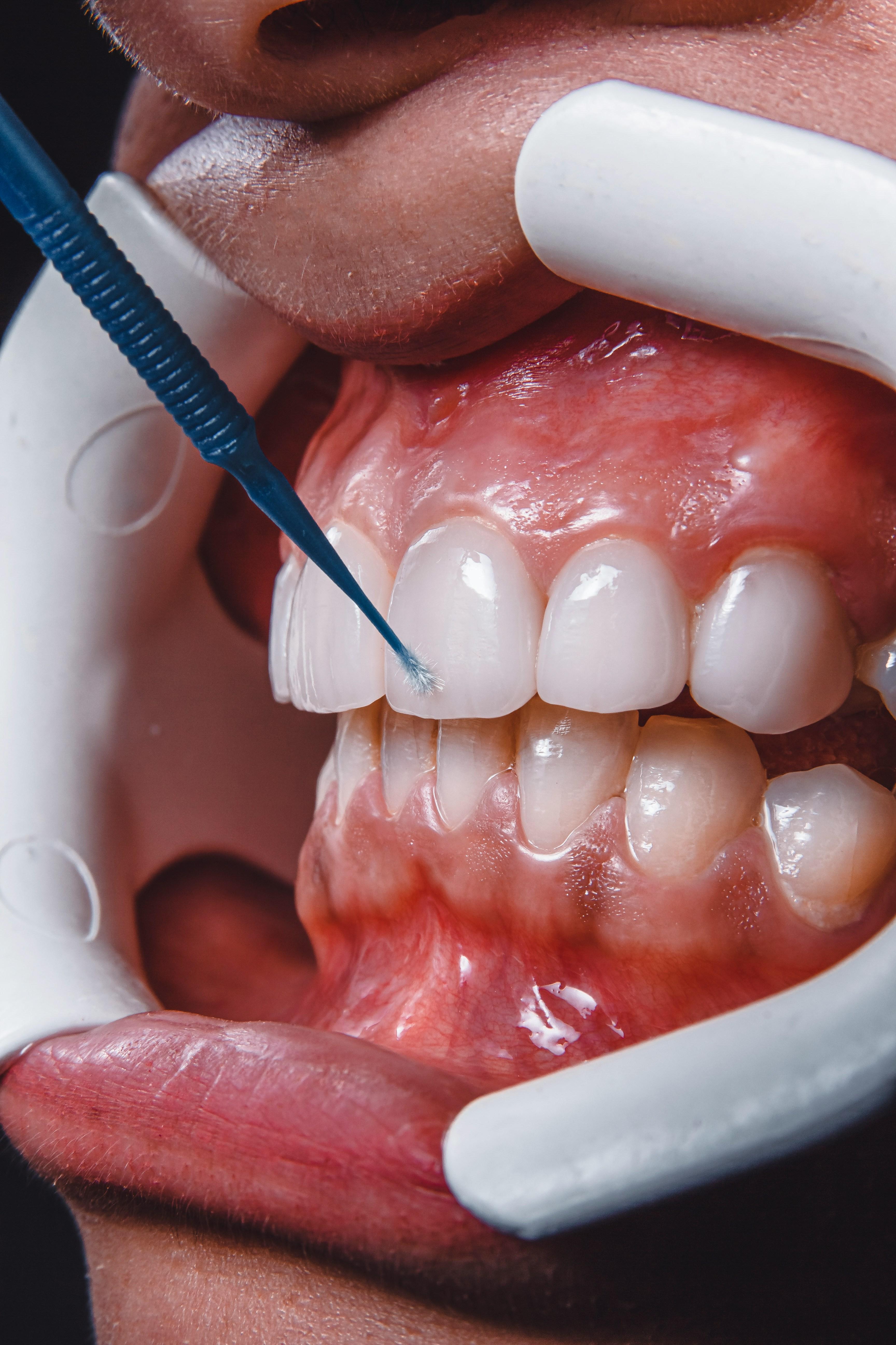 Smile transformation 1